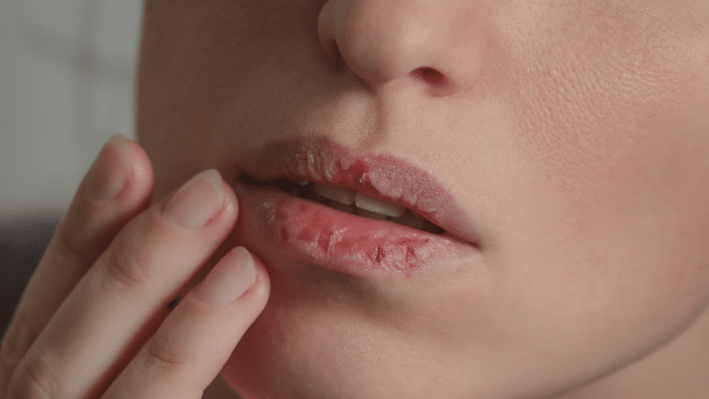 A wrong lip balm does more harm than good